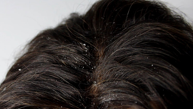 Helps-Eliminate-Dandruff