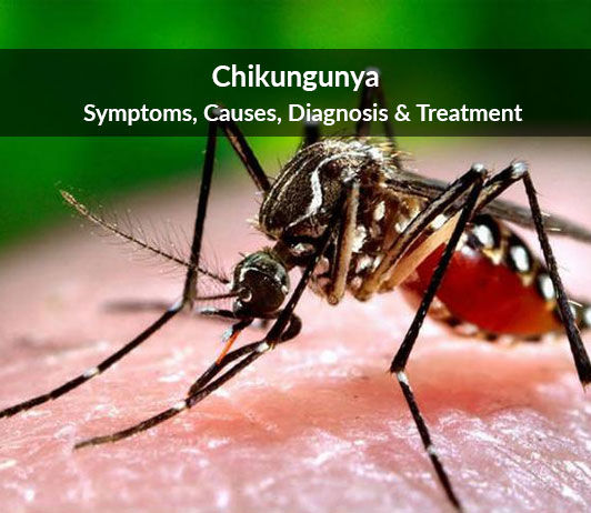 Chikungunya Chikungunya: Symptoms, Causes, Diagnosis & Treatment
