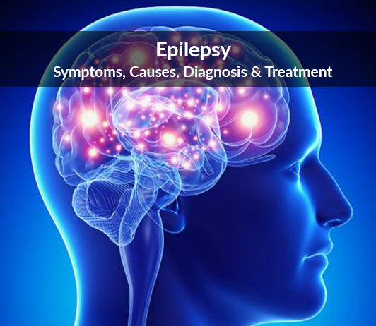 Epilepsy Epilepsy (Seizure Disorder): Symptoms, Causes, Diagnosis & Treatment