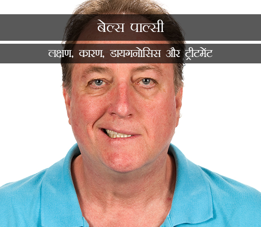 1 Bell’s Palsy in Hindi इडियोपैथिक फेसियल पैरालिसिस(बेल्स पाल्सी): लक्षण, कारण, डायगनोसिस और ट्रीटमेंट