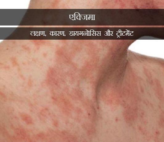 4 Eczema in Hindi एटोपिक डर्मिटीज(एक्जिमा): लक्षण, कारण, डायगनोसिस और ट्रीटमेंट