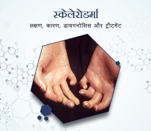 5 Scleroderma (Dermatosclerosis) in Hindi स्केलेरोडर्मा (डर्माटोस्क्लेरोसिस): लक्षण, कारण, डायगनोसिस और ट्रीटमेंट