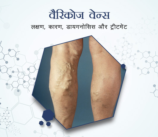 9 Varicose veins (Varicises) in Hindi वैरिकोज वेन्स: लक्षण, कारण, डायगनोसिस और ट्रीटमेंट