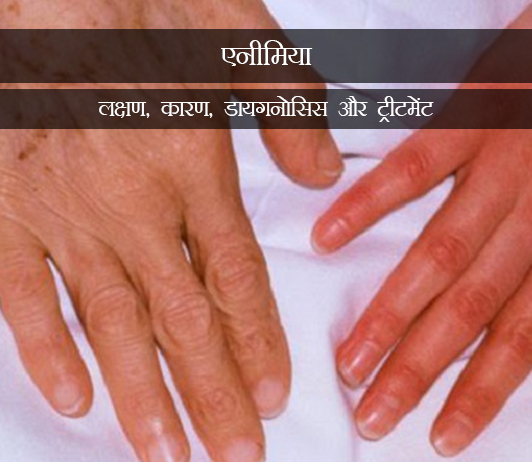 9 Anaemia in Hindi ब्लड लॉस (एनीमिया): लक्षण, कारण, डायगनोसिस और ट्रीटमेंट