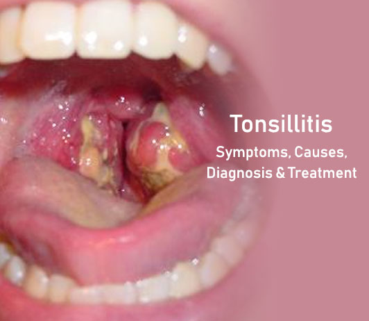 04-09_Tonsillitis Tonsillitis: Symptoms, Causes, Diagnosis & Treatment