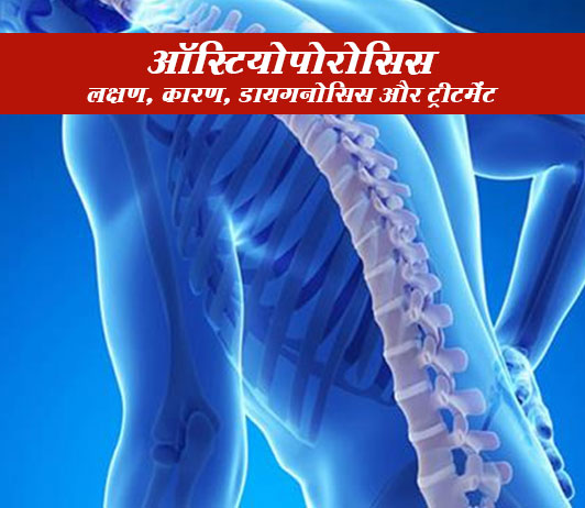 Osteoporosis In Hindi Osteoporosis In Hindi ऑस्टियोपोरोसिस: लक्षण, कारण, डायगनोसिस और उपचार