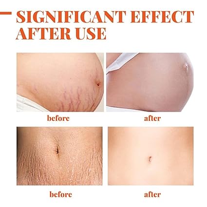Intimify Stretch Mark Removal Cream For Women