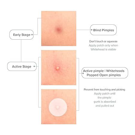 Priveda Acne Pimple Patch, Hydrocolloid Made in Korea 3 Sizes 8mm 10mm 12mm Waterproof Sheet