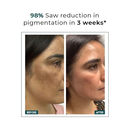 Conscious Chemist Kojic Acid Face Cream Trubiom | Anti Pigmentation Cream with Azelaic Acid Niacinamide for Dark Spot Reduction