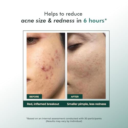 Conscious Chemist Rapid Relief Acne Spot Corrector Gel with 2 Percent Salicylic Acid and Azelaic Acid | Triple Action Pimple Treatment