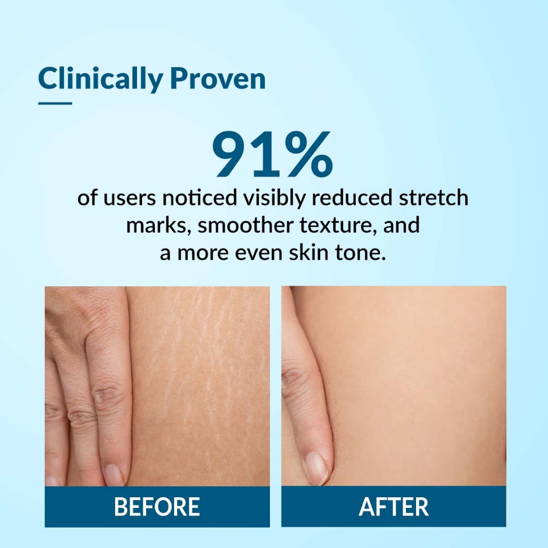 FIXDERMA Strallium Stretch Marks Cream | Dermatologist Tested | Clinically Proven | Skin Care